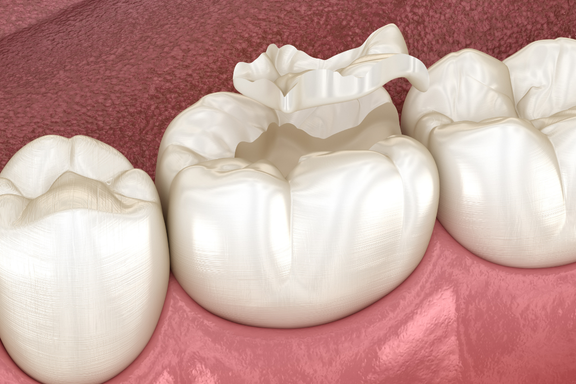 sealants dental dentistry of Livonia
