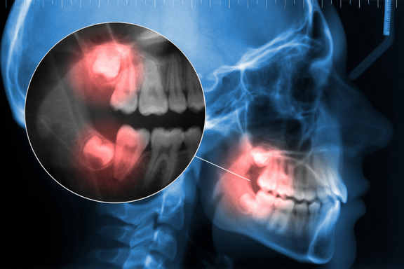 Wisdom Teeth Management dentistry of Livonia