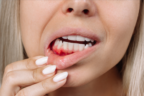 Gum Disease & Periodontal Treatments dentistry of Livonia